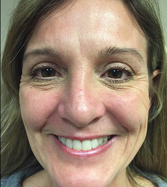 Micro Laser Peel before