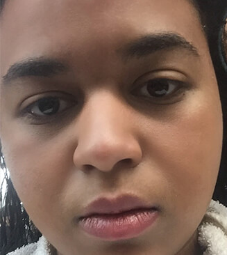 VI Peel after