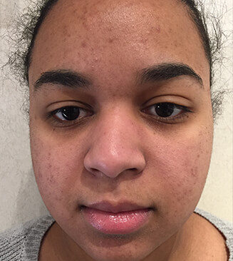 VI Peel before