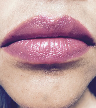 Lip Injection after