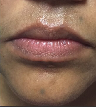 Lip Injection before