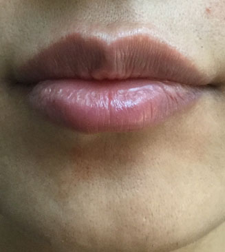 Lip Injection after