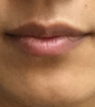 Lip Injection before
