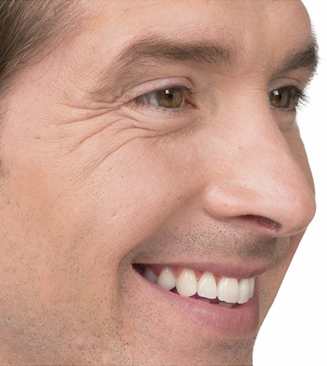 BOTOX® before