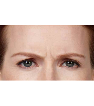 BOTOX® before