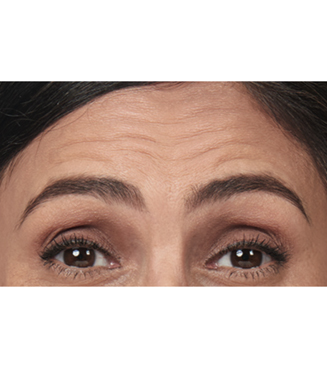 BOTOX® before