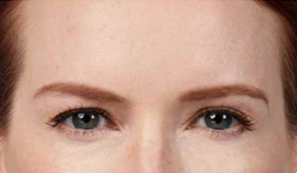 botox after