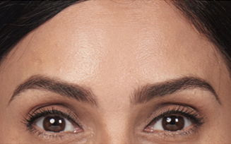 botox after