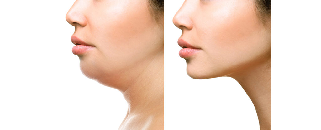 kybella before and after